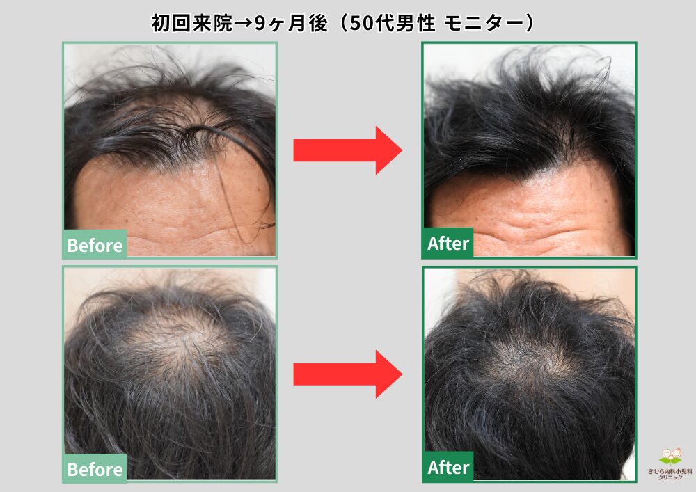 AGAモニター_Before-After